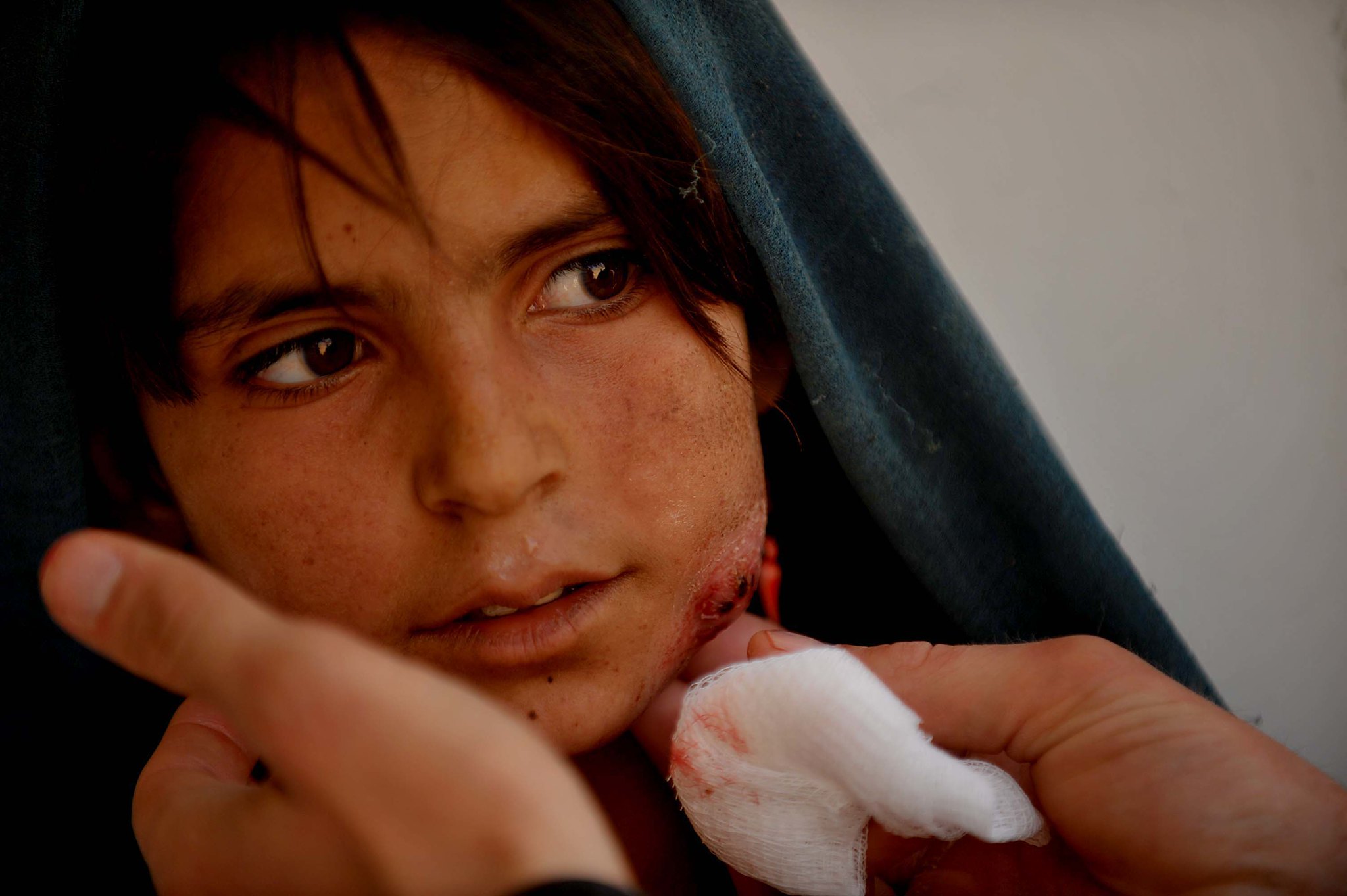 A young girl with a small wound on her face
