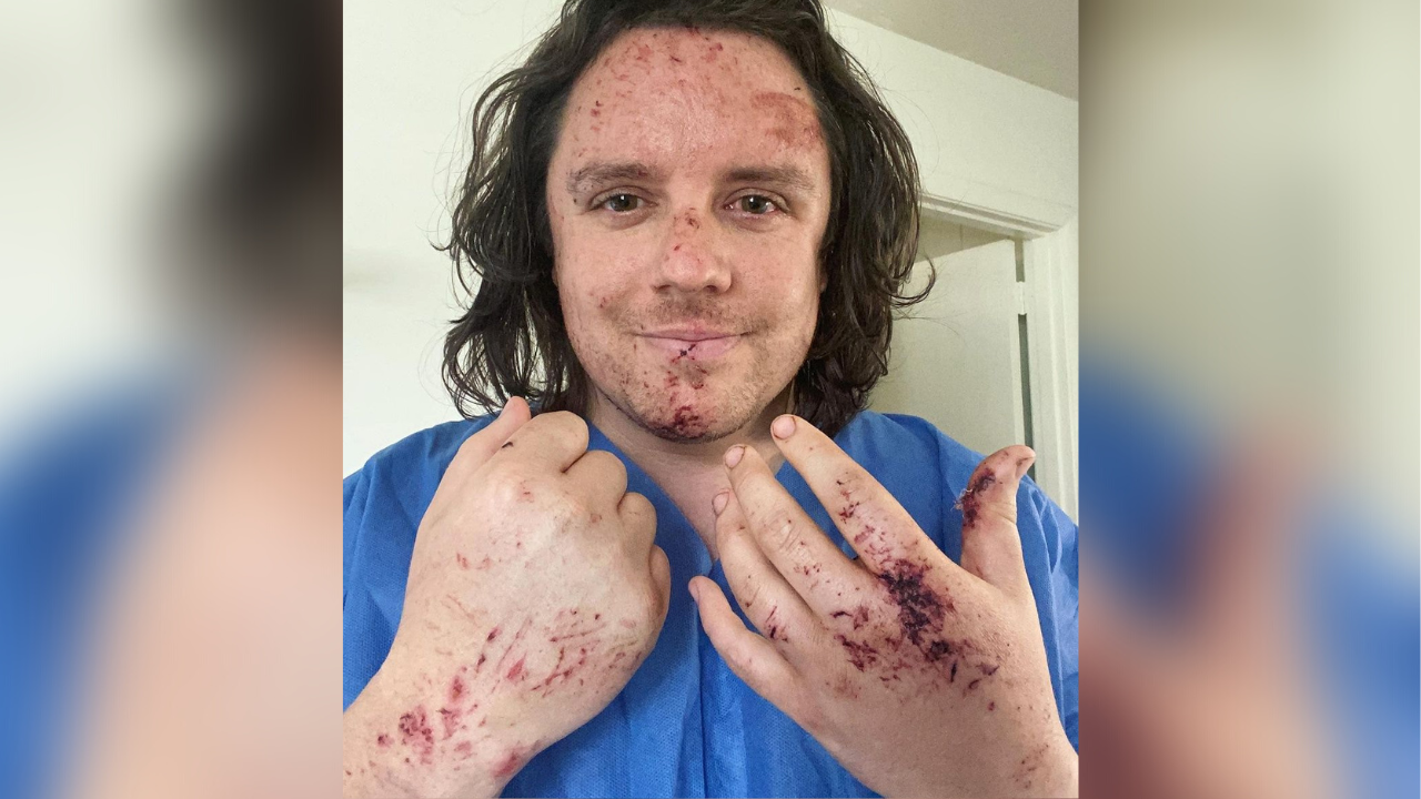 Jamie Kimmett holds up his hands which are covered in dried blood and scabs. His face also has many small cuts and dried blood.