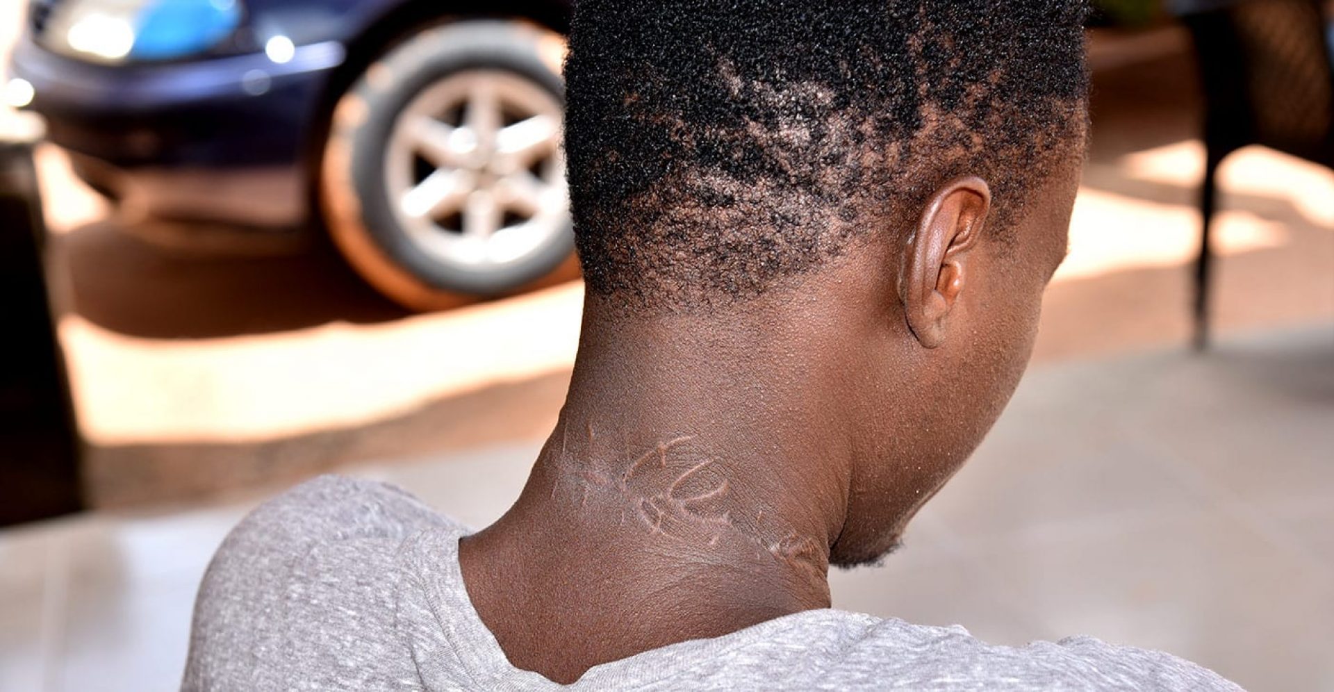 Scars on the back of a boy's neck